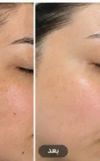 پوست شفاف و درخشان با تخفیف ویژه فیشال تخصصی