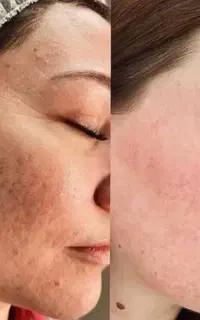 لیفت‌جوانسازی و روشنی وچربی سوزی