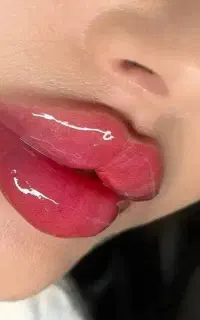 کلینیک جشنواره اقساط ژل بوتاکس مزو آنزیم نخ فیلر