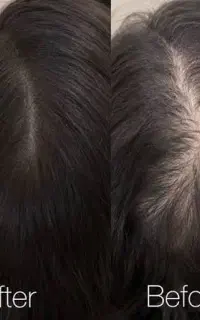 اسکالپ سر برای رفع کم پشتی مو ،شیدینگ لب،میکروابرو