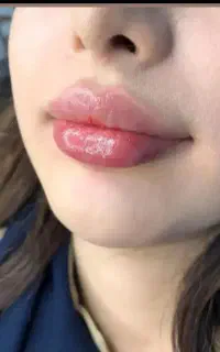فیلر ،بوتاکس،چربی