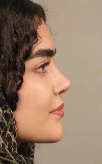 عمل بینی ویژه مراجعین اندیمشک،در تهران/۵۰