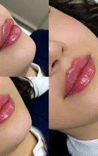 اف ویژه بوتاکس ۱/۵۰۰ فیلر لب ۵ میلیون