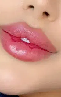 تخفیف اموزش فیلر و بوتاکس