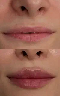 بهترین خدمات زیبایی ژل بوتاکس فیلر مزوژل لیزر