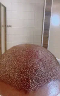 کاشت مو طبیعی در شهر بافق
