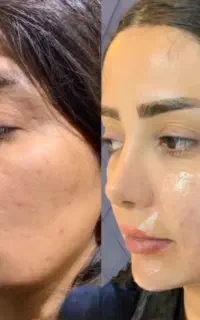 هایفو صورت و هایفو واژن