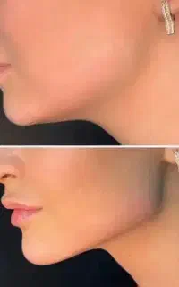 آموزش فیلربادی‌ و انجام خدمات ژل بوتاکس فیلر
