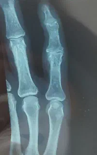 شکسته بندی کریمی