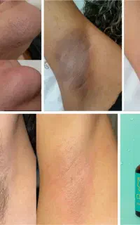 رفع موهای زائد بدون لیزر (پرداخت درب منزل)