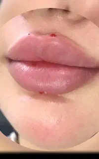 تزریق تخصصی ژل و بوتاکس
