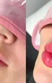 ژل،بوتاکس،فیلربادیپیرسینگ،کاشت نخ