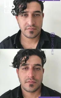 جراحی بینی فیلربینی رفع قوز بینی لیفت و کوچک کردن