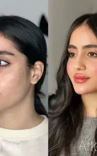 انجام ژل ،نخ ،چربی، پی ار پی،مزو