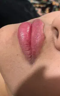 فیلر،مزوژل،بوتاکس