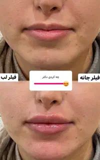 اموزش ژل و بوتاکس لیزر پی ارپی