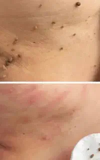 برداشتن خال زگیل میخچه باقیمت فوق العاده توسط پزشک