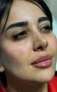 واژینوپلاستی لابیاپلاستی و رفع تیرگی