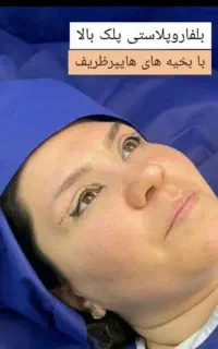 لیپو ساکشن ابدو عمل بینی  لیفت اموزش