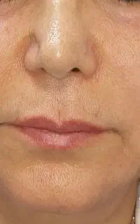 جوانسازی قوی بدون مواد