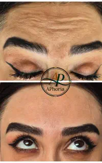 بوتاکس ، فیلر ،ژل ،مزو با تخفیفات ویژه