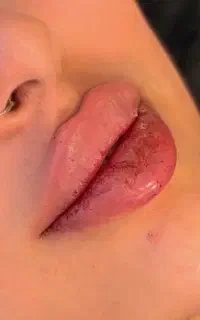 ژل هر سی سی از ۴۹۰ بوتاکس از ۶۹۰ آموزش۶۹۰۰