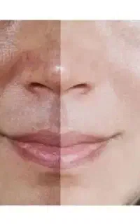 پیگمنتا سفید کننده پوست