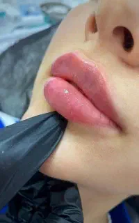 جشنواره تزریق فیلر، ژل ،بوتاکس به مدت محدود