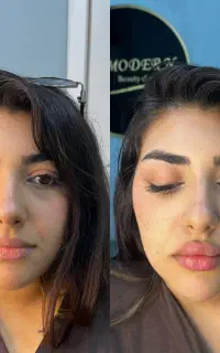 تزریق ژل فیلر و بوتاکس توسط پزشک مجرب