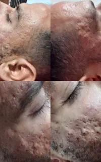 رفع جای سالک جوش ترک خال و رد بخیه بلفاروپلاستی