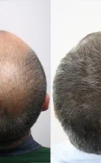 قبل اقدام به کاشت اینو حتما ببین