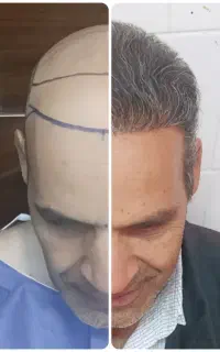 کاشت تخصصی مو فقط ۲۵ میلیون