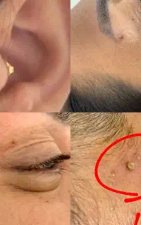 تخفیف ویژه برداشت خال،زگیل،منگوله،انجام پرسینگ