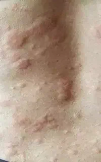 درمان حساسیت ،کهیر توسط پزشک متخصص