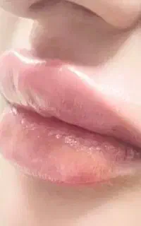 لیزر، فشیال تخصصی. تزریق ژل تمام نقاط بدن