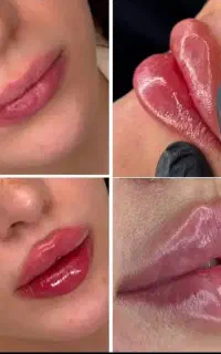 ژل و بوتاکس و لیزر در مطب با قیمت استثنایی