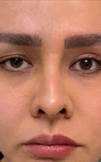 بلفاروپلاستی (جراحی زیبایی پلک)