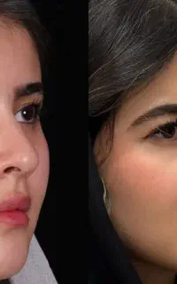 جراحی بینی ویژه با تخفیف ویژه ۵۰درصد