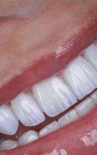 ایمپلنت  ،زیبایی با اقساط و تخفیف ویژه