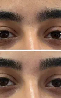 بندو‌ابرو تخصصی / موخوره گیری روسی