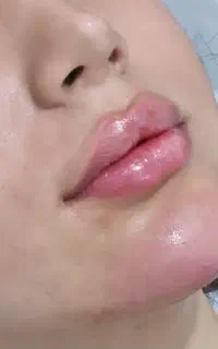 آموزش تزریق ژل وبوتاکس کلینیک  ،پی ارپی ، بایوفیلر