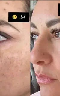 ضد لک بیوممتیک (تضمینی و بدون بازگشت )
