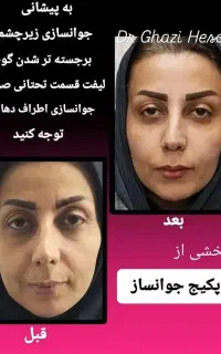 لیزر تزریق بوتاکس ژل فیلر مزوتراپی هایفو توسط پزشک