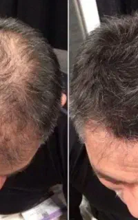 جوانسازی ناحیه کم پشت