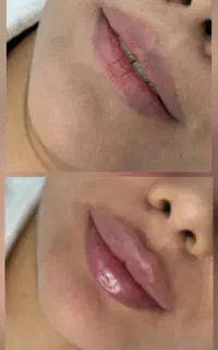 تزریق فیلر صورت بوتاکس  وفیلر بادی جوانسازی صورت