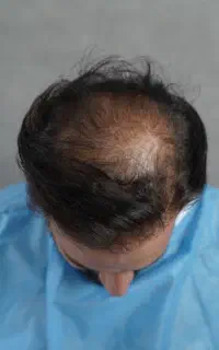 کاشت مو اردبیل /میکروگرافت / ۲۰ میلیون