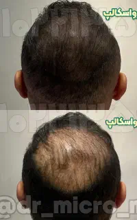 اسکالپ سر و سبیل و ریش و جای بخیه