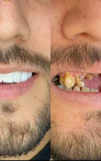 دندانپزشکی، کامپوزیت، عصب کشی، روکش