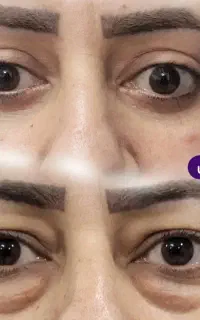 بلفاروپلاستی ( شوش ، اهواز ، شوشتر )