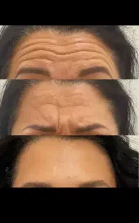 فیشیال جوانسازی